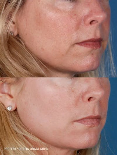 Skin Care Before & After Gallery - Patient 49268468 - Image 1
