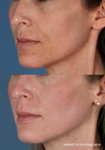 Skin Care Before & After Gallery - Patient 49268469 - Image 1