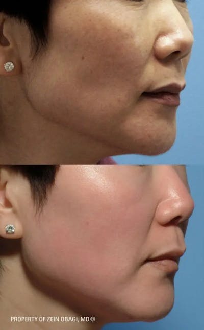 Skin Care Before & After Gallery - Patient 49268470 - Image 1