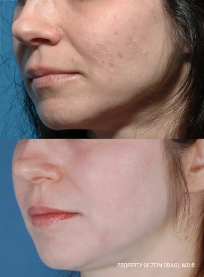 Skin Care Before & After Gallery - Patient 49268471 - Image 1