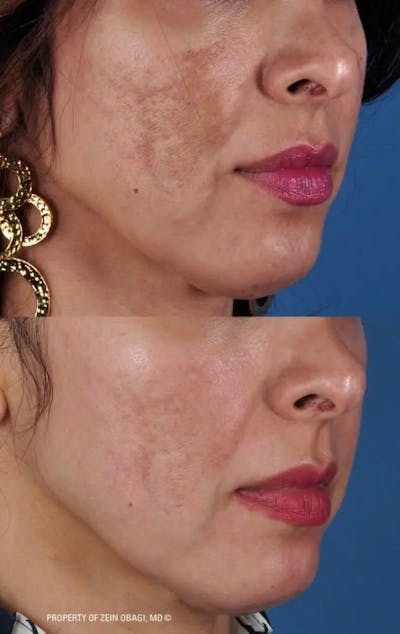 Skin Care Before & After Gallery - Patient 49268472 - Image 1