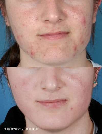Skin Care Before & After Gallery - Patient 49268473 - Image 1
