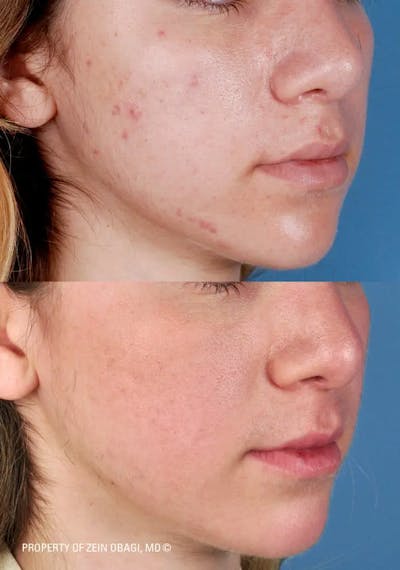 Skin Care Before & After Gallery - Patient 49268474 - Image 1