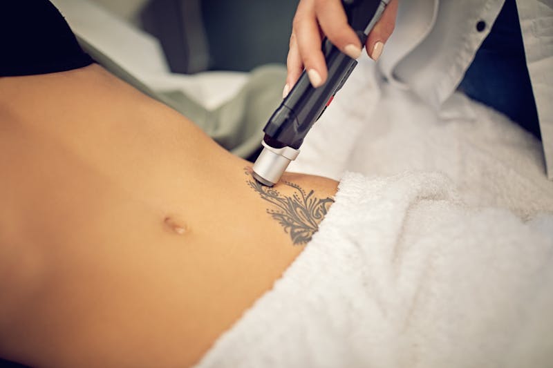 How Long Does It Take to See Results of a Laser Tattoo Removal? | Blog |  Neaman Plastic Surgery & Medi Spa
