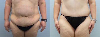 Tummy Tuck Before & After Gallery - Patient 75529729 - Image 1