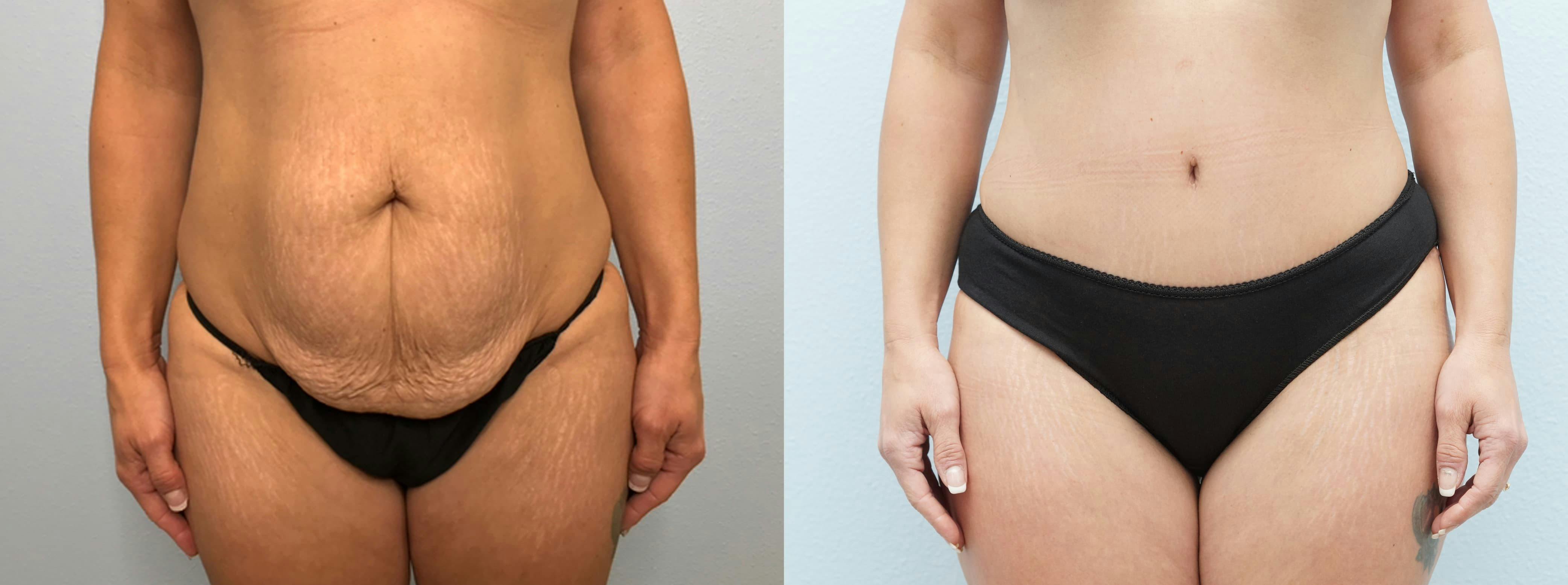 Tummy Tuck Gallery - Patient 75529802 - Image 1