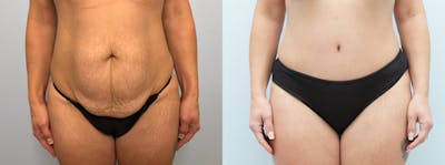Tummy Tuck Before & After Gallery - Patient 75529802 - Image 1