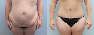 Tummy Tuck Before & After Gallery - Patient 75529858 - Image 1