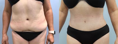 Tummy Tuck Before & After Gallery - Patient 75529872 - Image 1