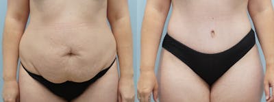 Tummy Tuck Before & After Gallery - Patient 75529981 - Image 1