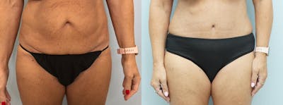 Tummy Tuck Before & After Gallery - Patient 75530454 - Image 1