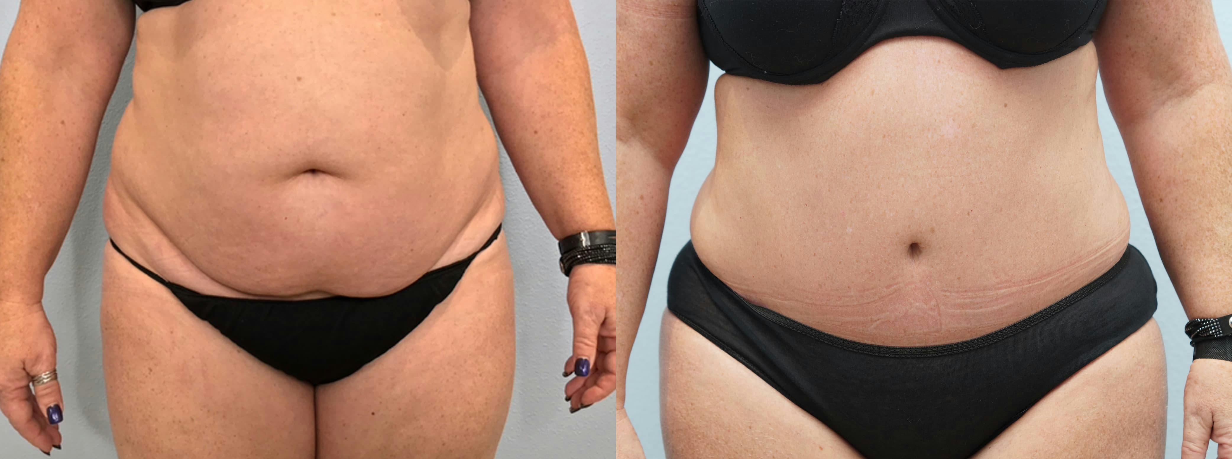 Tummy Tuck Gallery - Patient 75531895 - Image 1