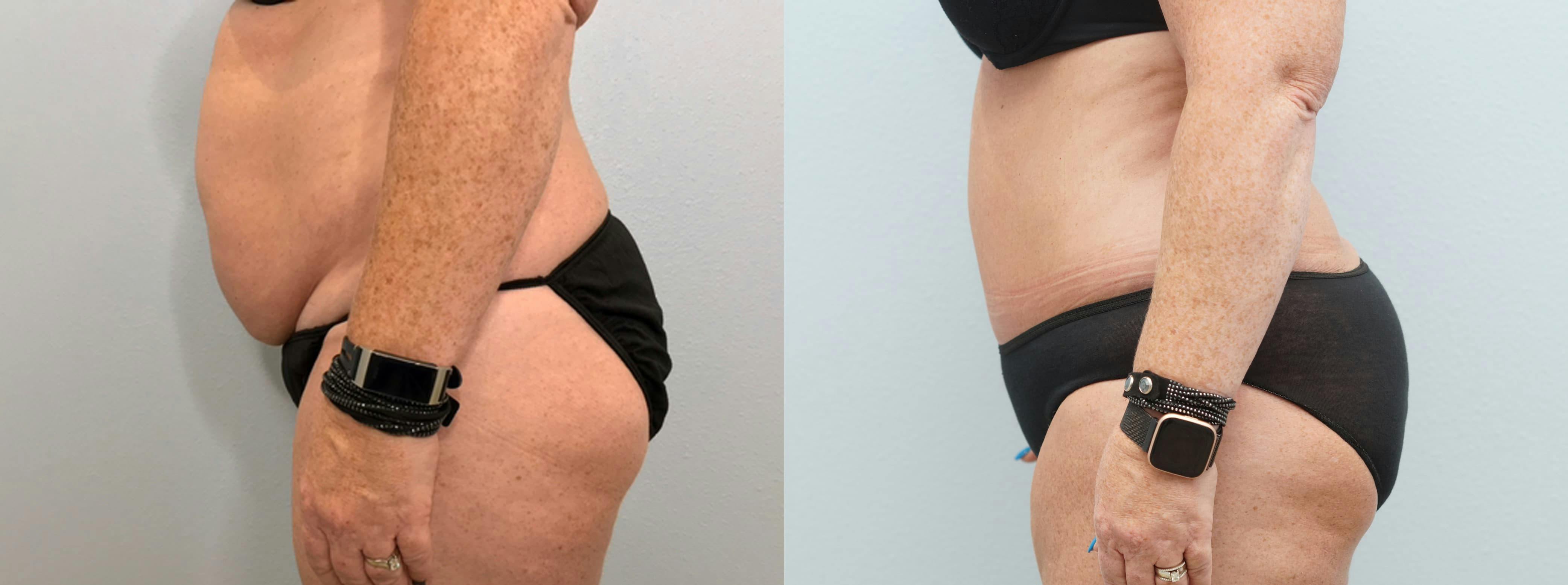 Tummy Tuck Gallery - Patient 75531895 - Image 6