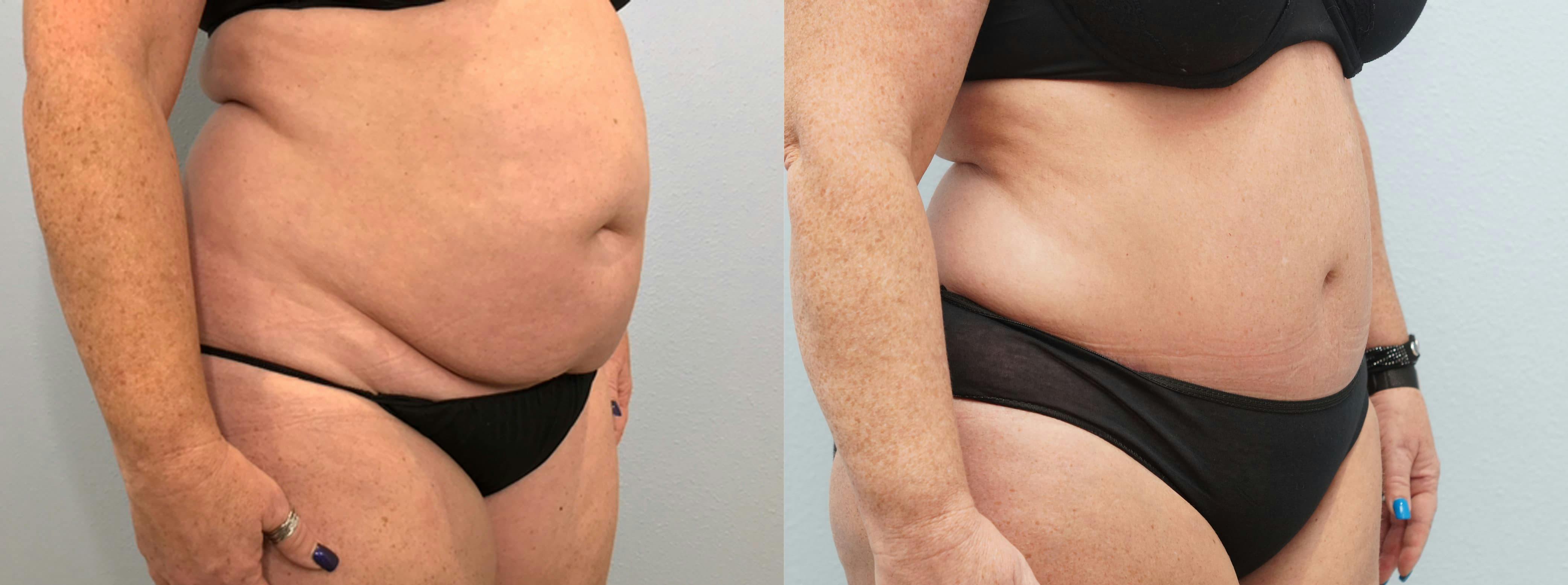 Tummy Tuck Gallery - Patient 75531895 - Image 3