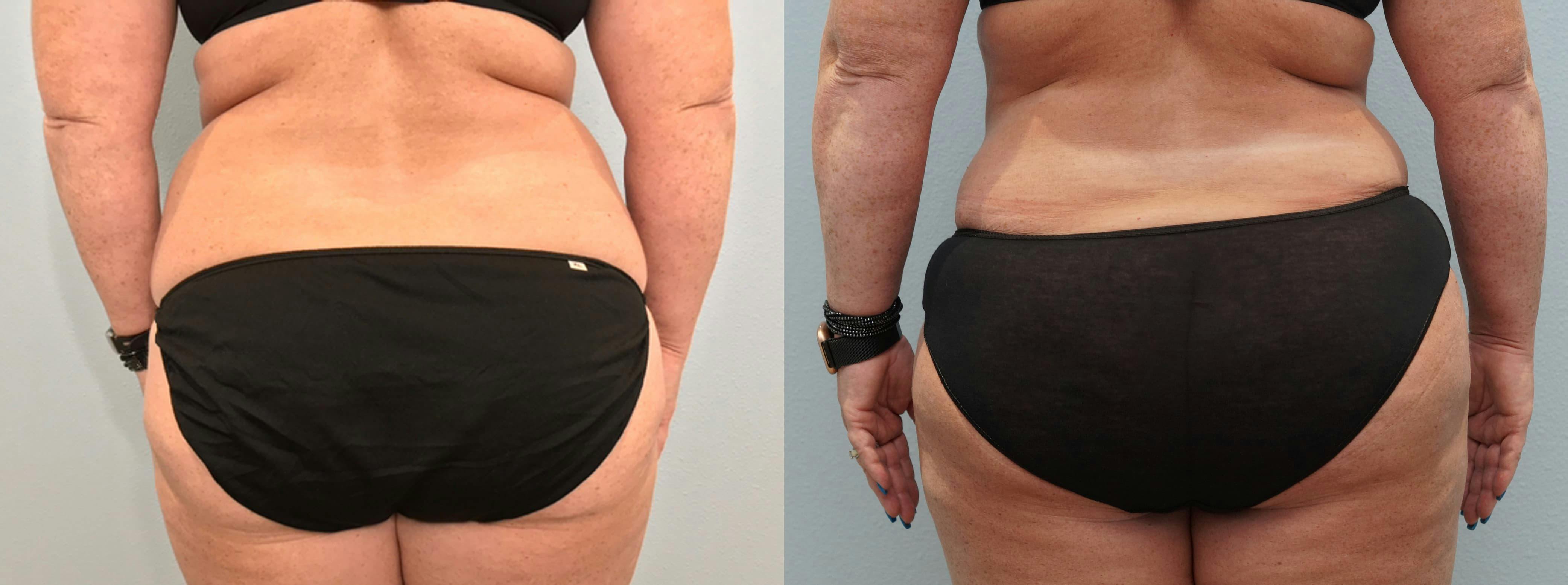 Tummy Tuck Gallery - Patient 75531895 - Image 2