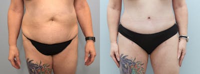 Tummy Tuck Before & After Gallery - Patient 75533246 - Image 1