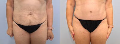 Tummy Tuck Before & After Gallery - Patient 75537597 - Image 1