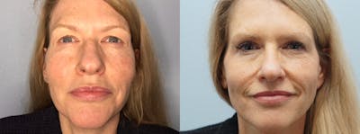 Eyelid Surgery Before & After Gallery - Patient 75538057 - Image 1