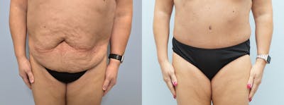 Body Lift Before & After Gallery - Patient 75538171 - Image 1