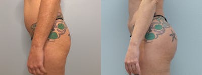 Brazilian Butt Lift Before & After Gallery - Patient 75538899 - Image 1