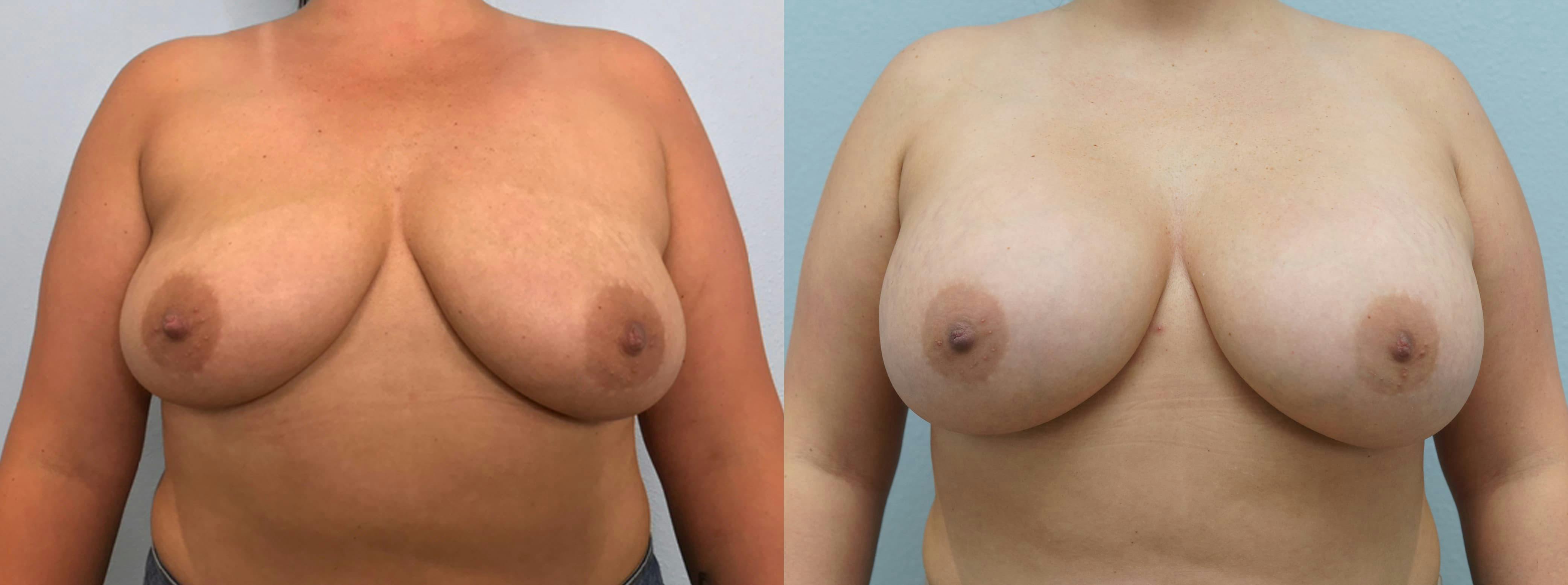 Breast Augmentation Gallery - Patient 75538935 - Image 1