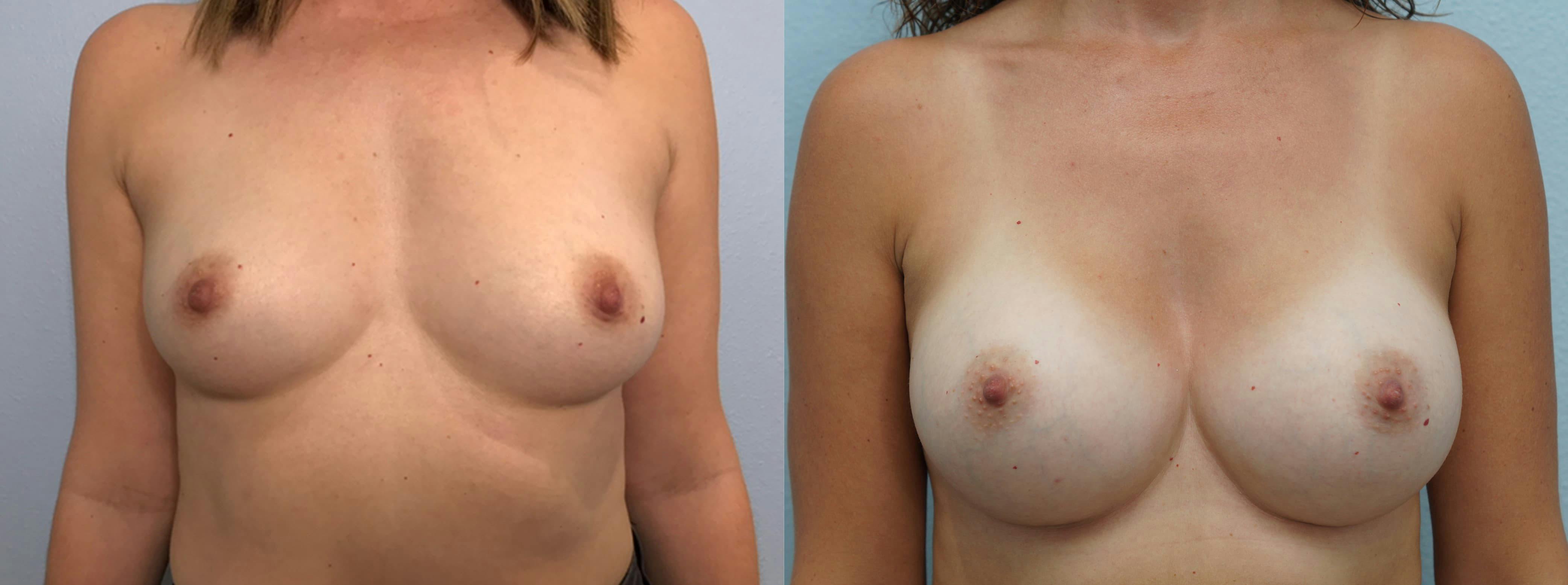 Breast Augmentation Gallery - Patient 75538949 - Image 1