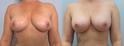 Breast Augmentation Before & After Gallery - Patient 75538982 - Image 1