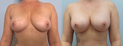 Breast Augmentation Gallery - Patient 75538982 - Image 1