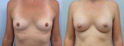 Breast Augmentation Before & After Gallery - Patient 75539313 - Image 1