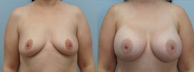 Breast Augmentation Before & After Gallery - Patient 75539336 - Image 1