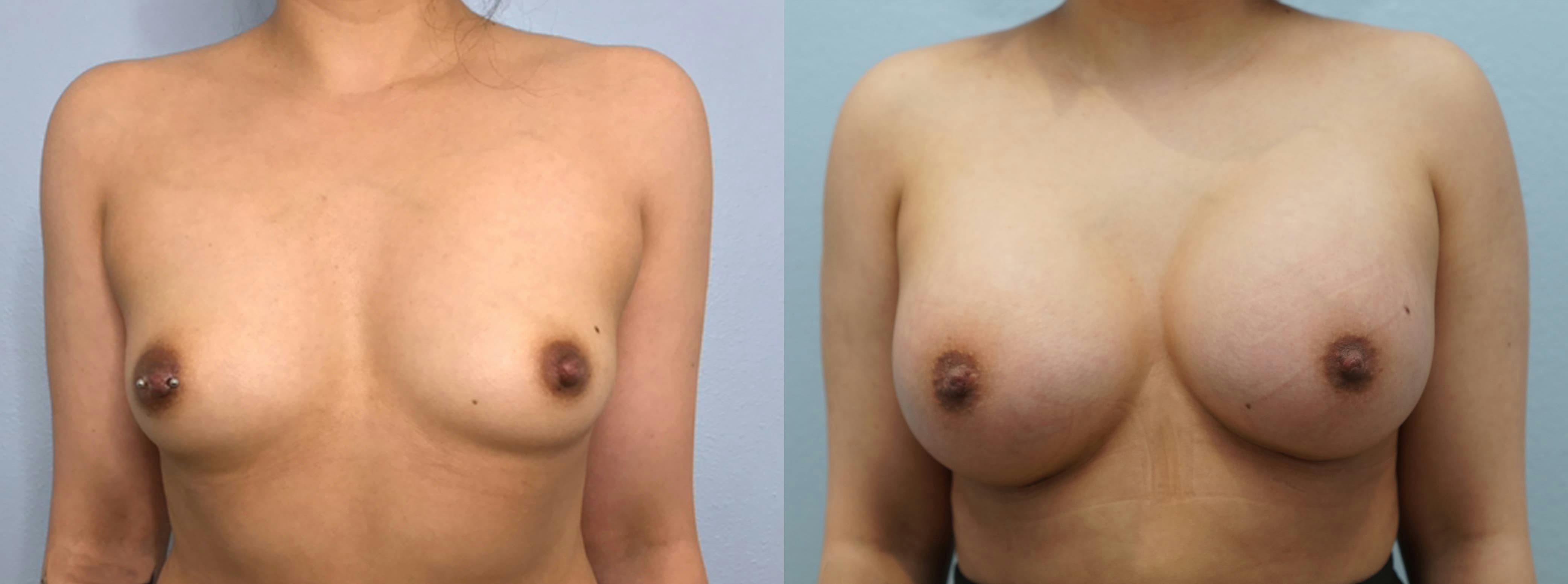 Breast Augmentation Gallery - Patient 75539358 - Image 1