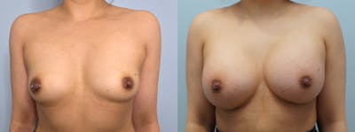 Breast Augmentation Before & After Gallery - Patient 75539358 - Image 1