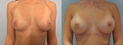 Breast Augmentation Before & After Gallery - Patient 75539399 - Image 1