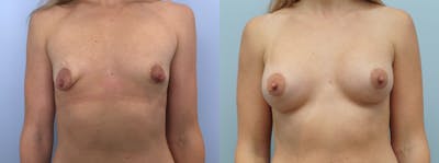 Breast Augmentation Before & After Gallery - Patient 75539416 - Image 1