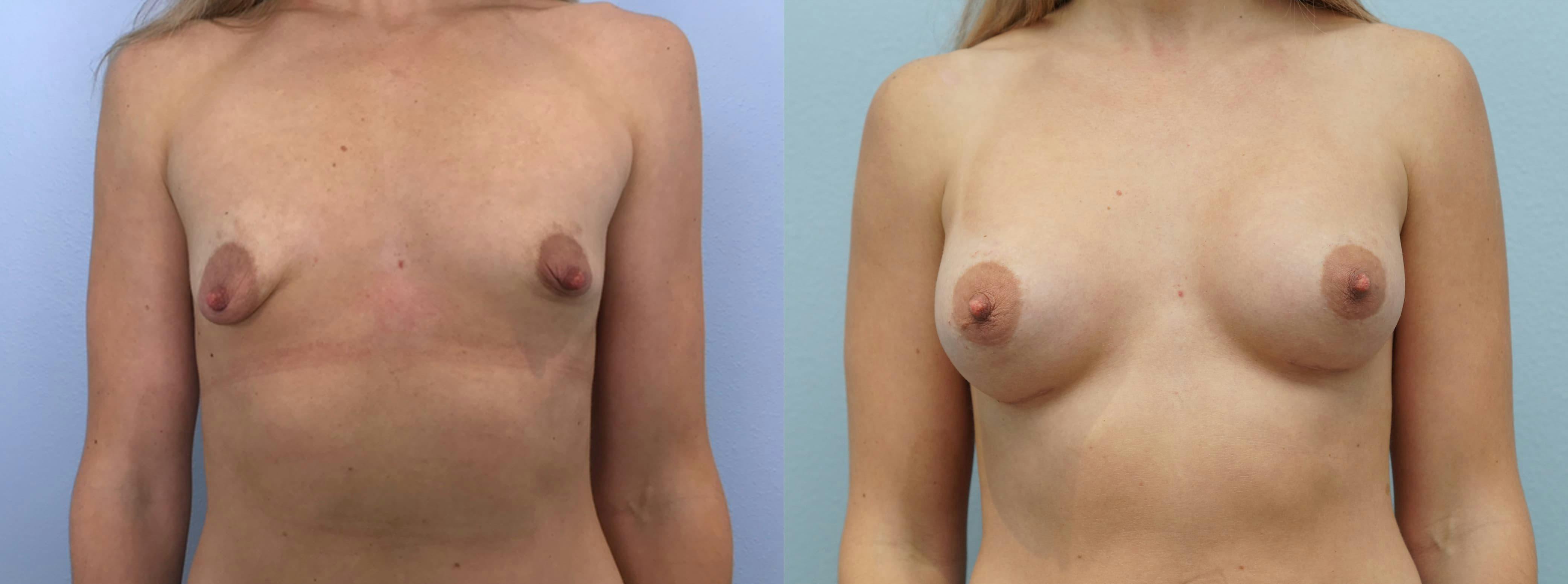 Breast Augmentation Gallery - Patient 75539416 - Image 1