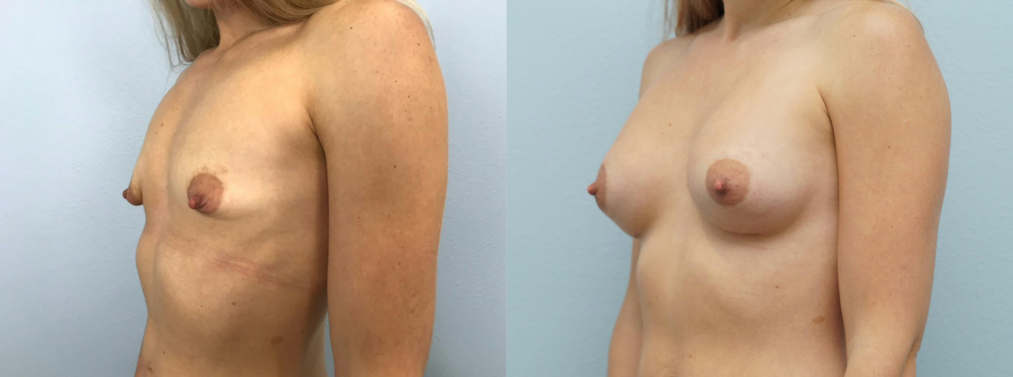 Breast Augmentation Gallery - Patient 75539416 - Image 4