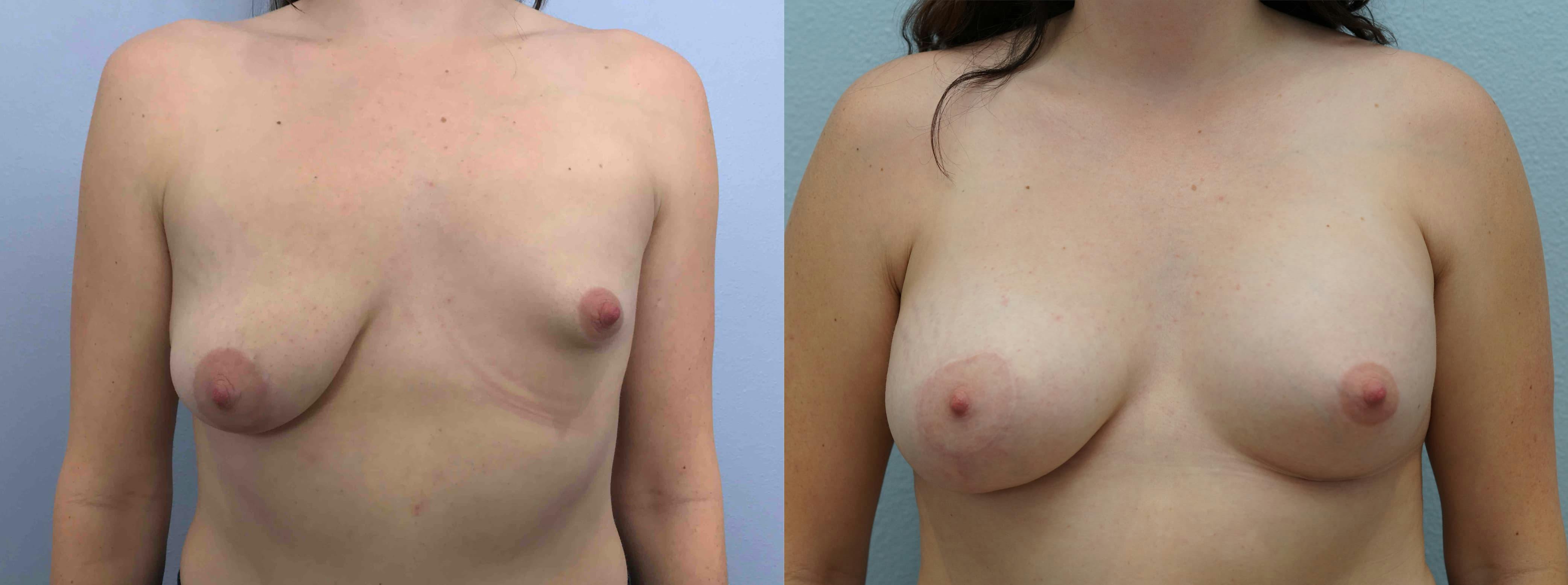 Breast Lift With Implants Gallery - Patient 75539521 - Image 1