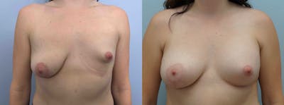 Breast Lift With Implants Before & After Gallery - Patient 75539521 - Image 1
