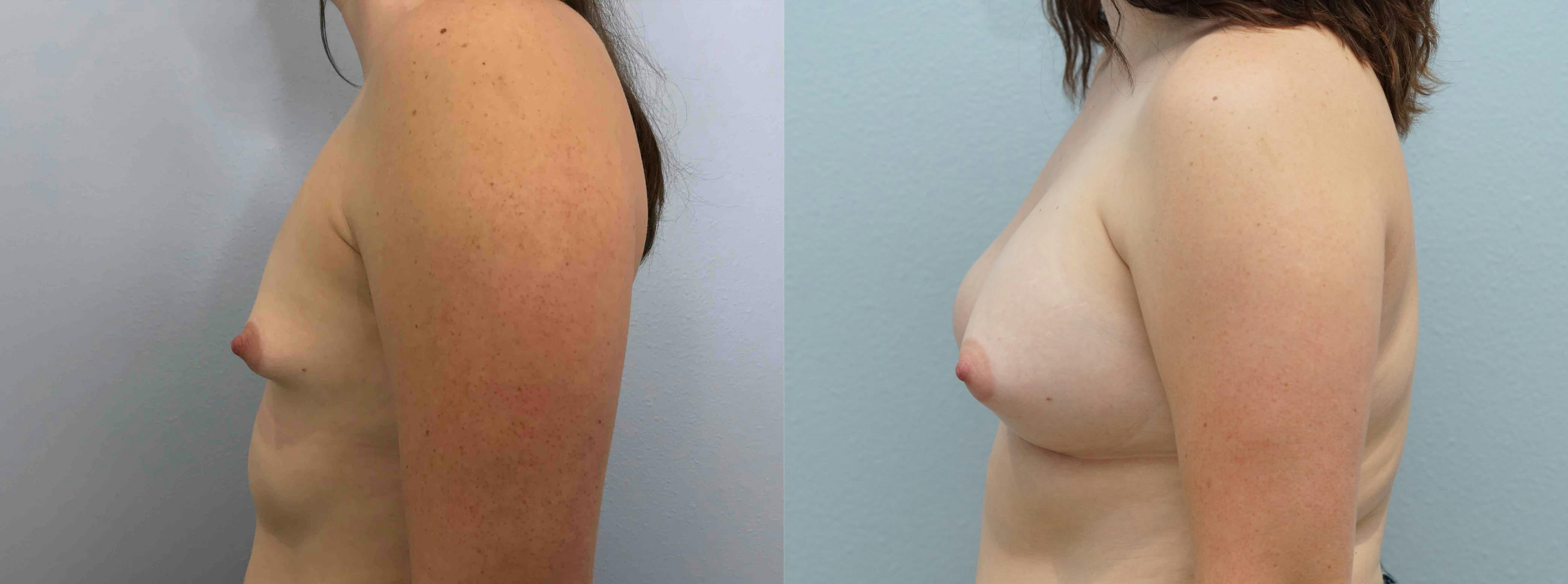 Breast Lift With Implants Gallery - Patient 75539521 - Image 5