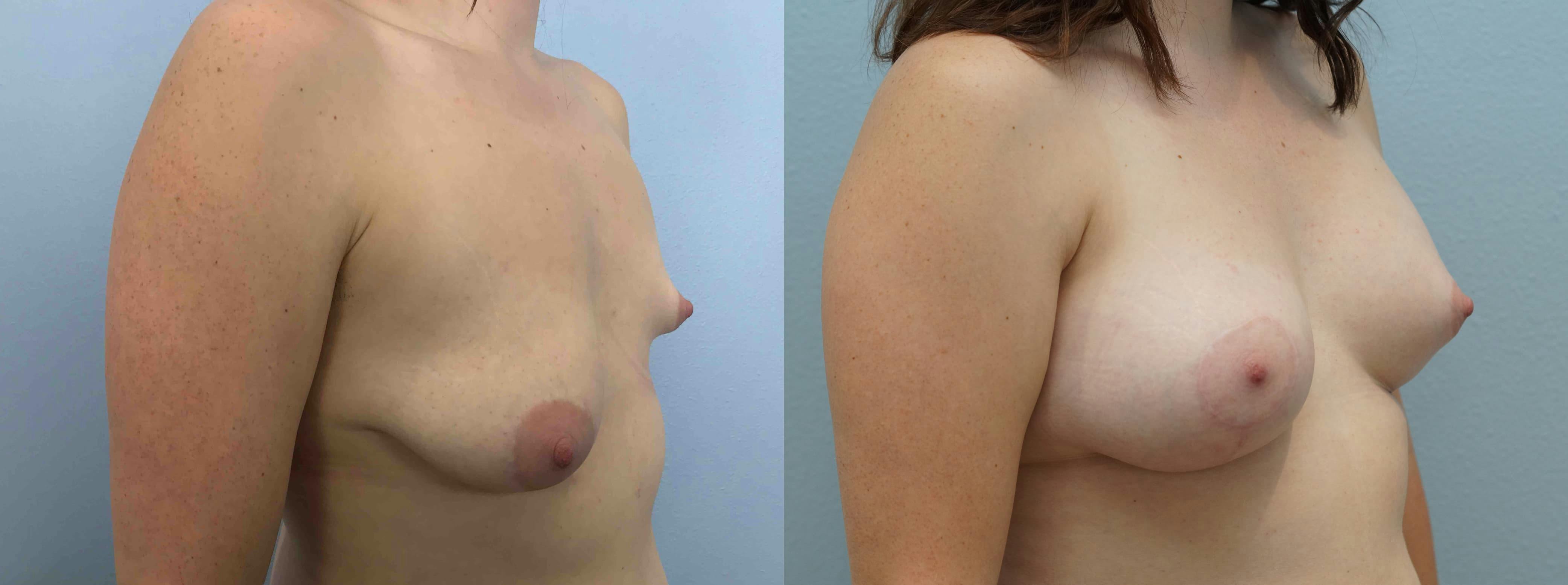 Breast Lift With Implants Gallery - Patient 75539521 - Image 2