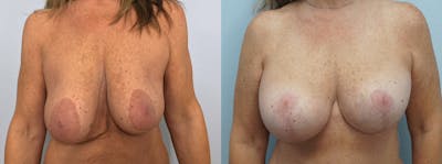 Breast Lift With Implants Before & After Gallery - Patient 75539662 - Image 1