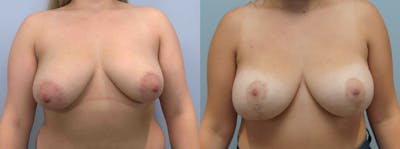 Breast Lift With Implants Before & After Gallery - Patient 75539711 - Image 1