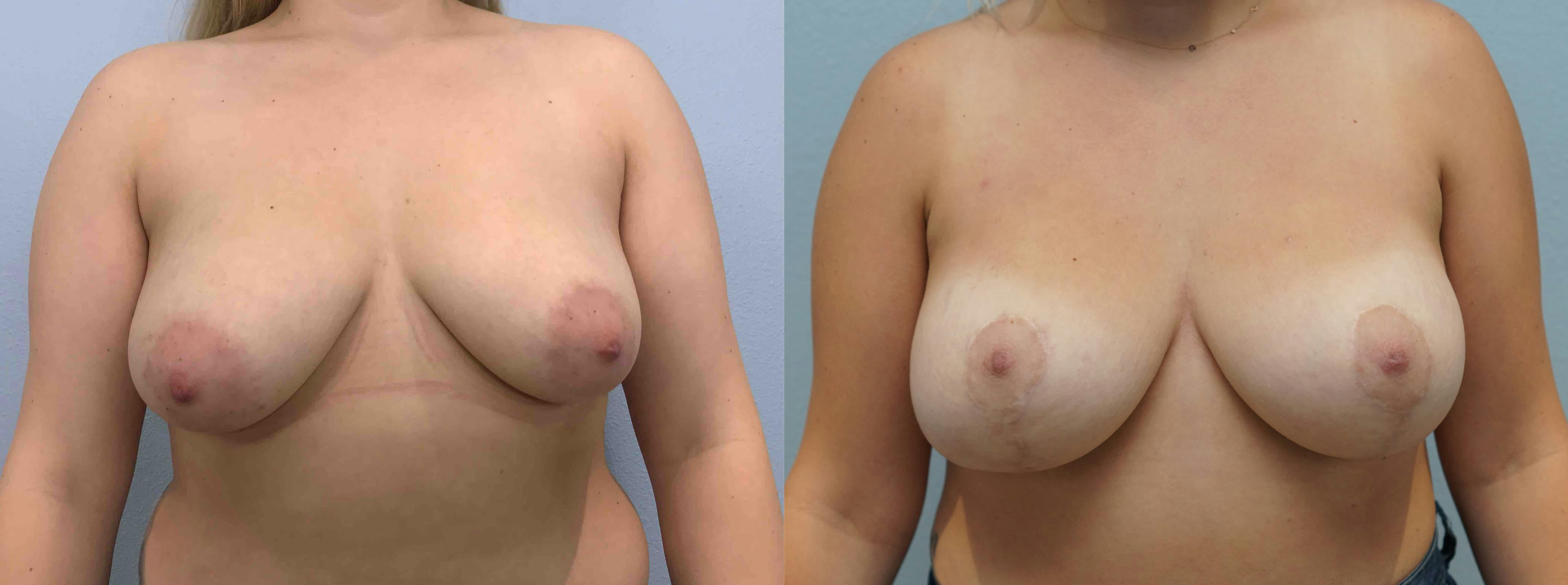 Breast Lift With Implants Gallery - Patient 75539711 - Image 1