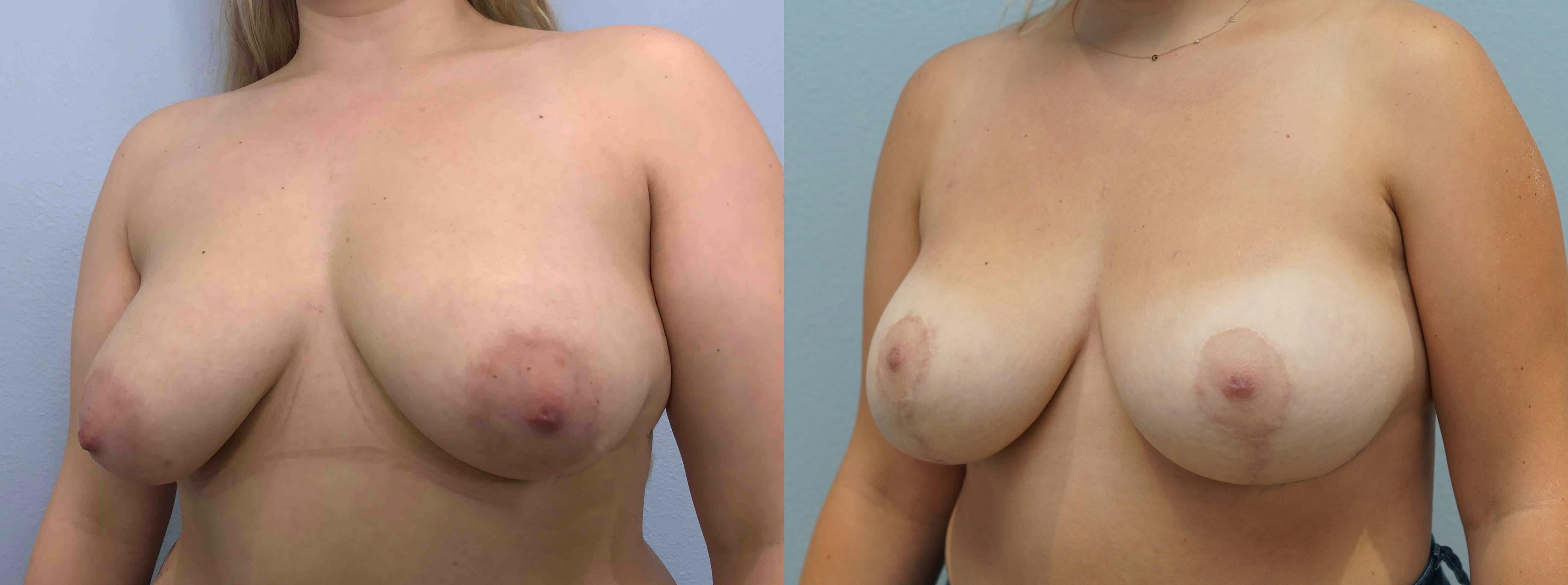 Breast Lift With Implants Gallery - Patient 75539711 - Image 4
