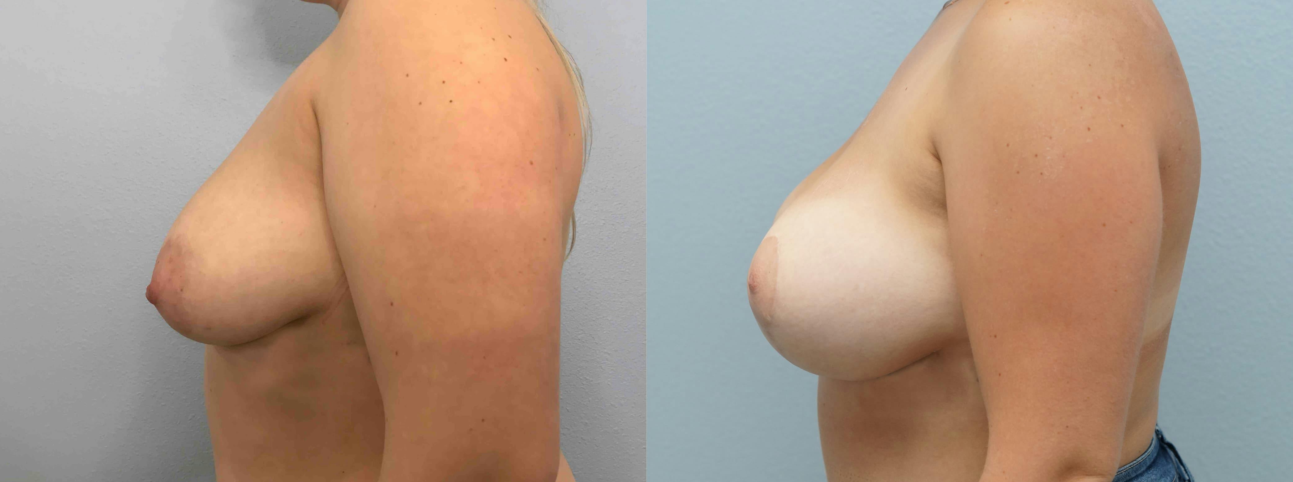 Breast Lift With Implants Gallery - Patient 75539711 - Image 5