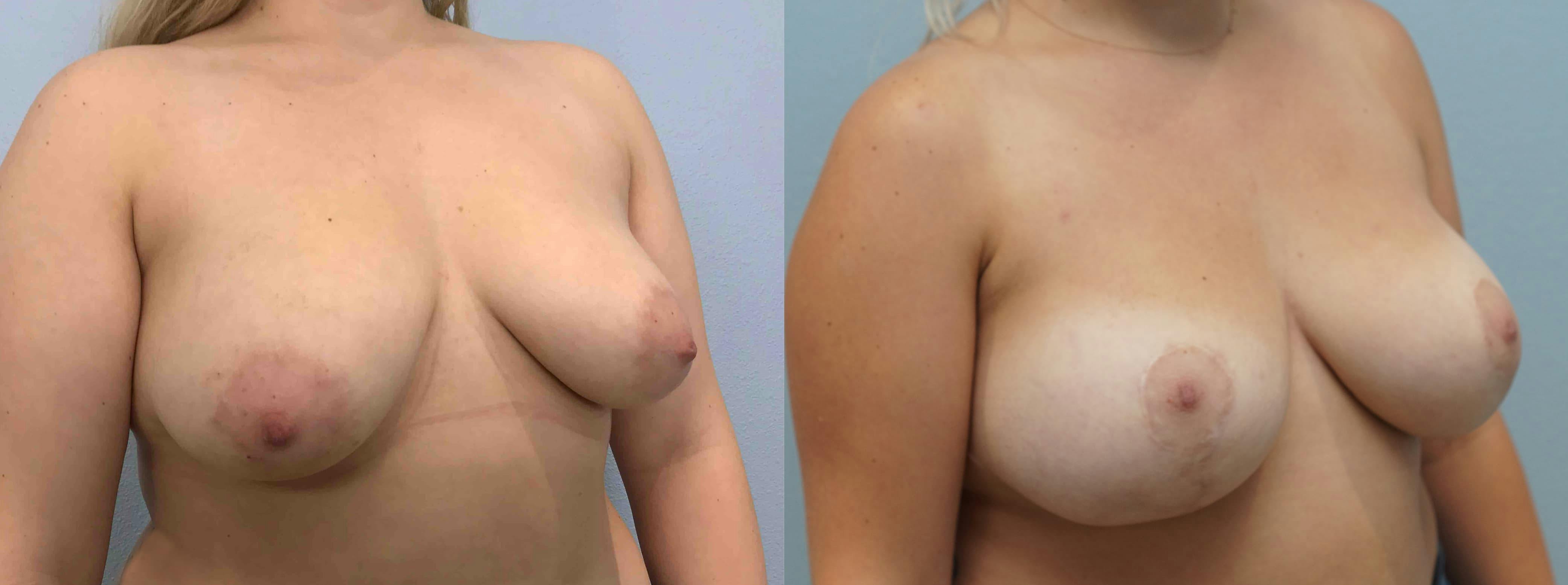 Breast Lift With Implants Gallery - Patient 75539711 - Image 2