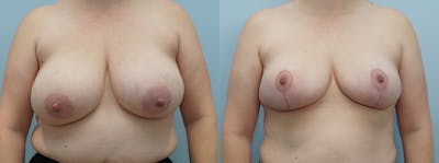Breast Reduction Before & After Gallery - Patient 75539726 - Image 1