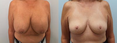 Breast Revision Before & After Gallery - Patient 75539739 - Image 1