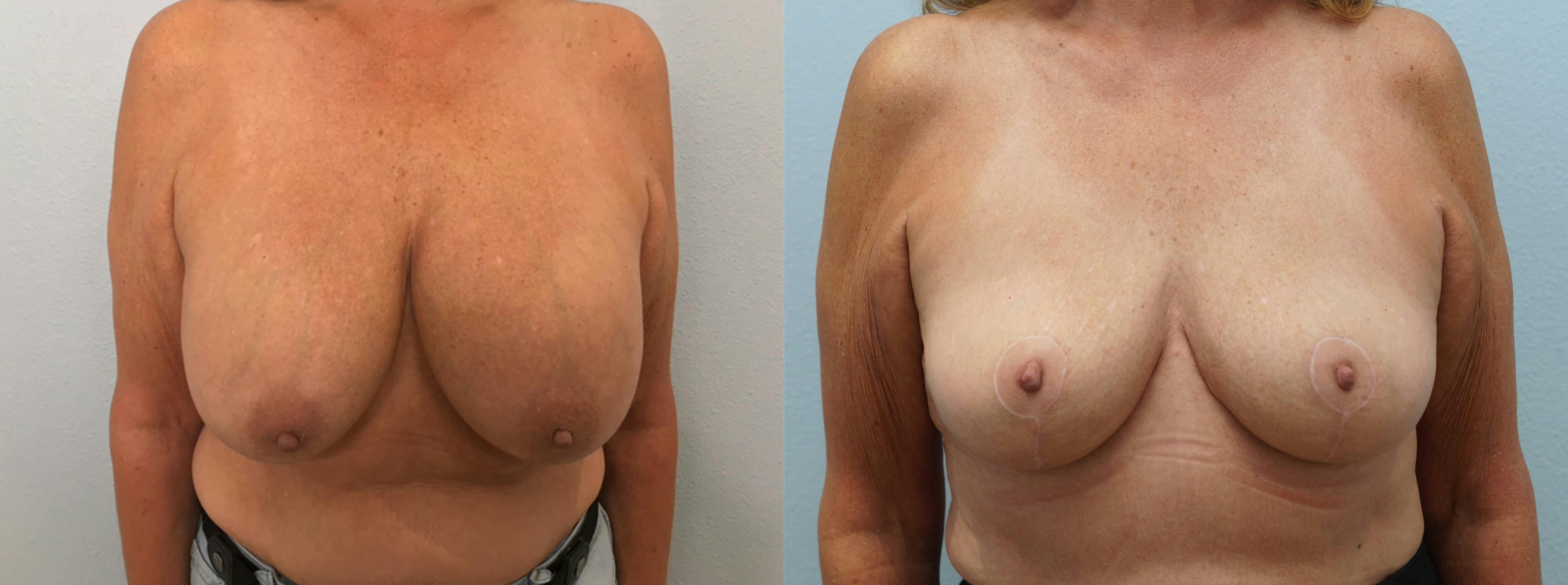 Breast Revision Gallery - Patient 75539739 - Image 1