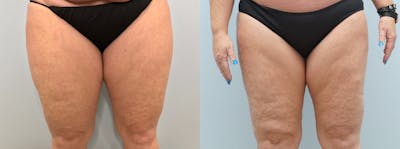 Liposuction Before & After Gallery - Patient 75539816 - Image 1